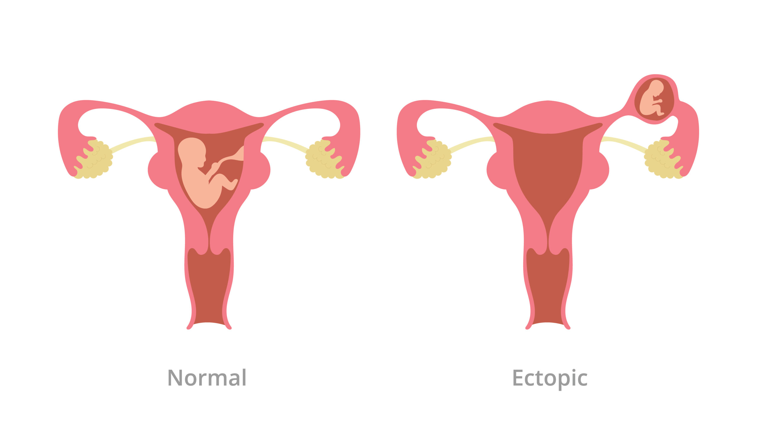 Ectopic Pregnancy